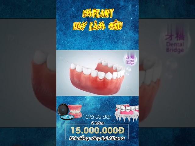 [3D] IMPLANT HAY CẦU RĂNG || Nha Khoa Quốc Tế Athena