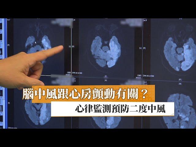 【張谷州醫師】腦中風跟心房顫動有關？　心律監測預防二度中風｜健康醫療網