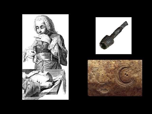 Trephination at Jamestown