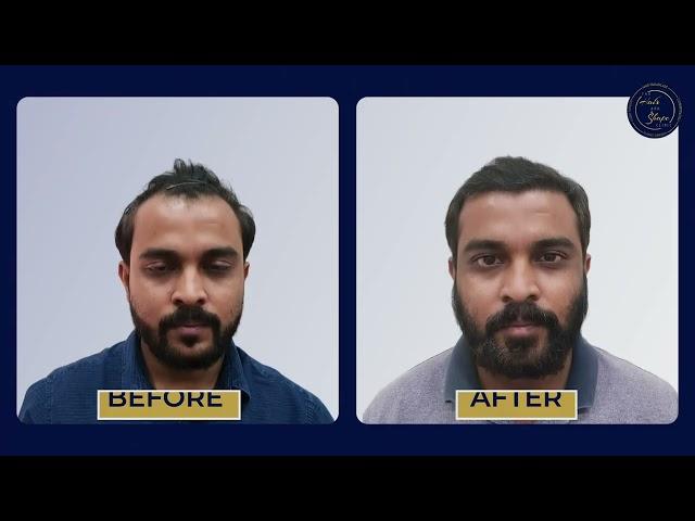 7-Month Hair Transplant Transformation | The Hair And Shape Clinic Mumbai