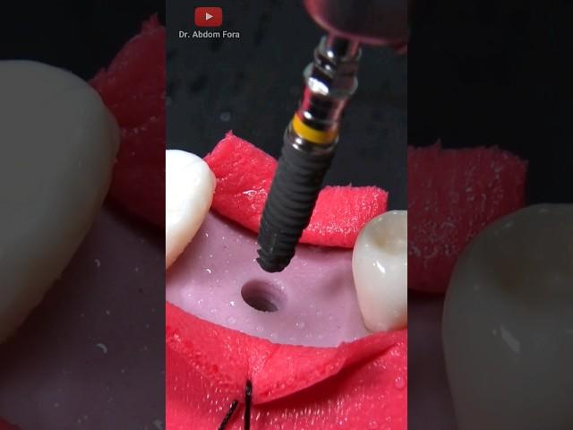 Tooth implant procedure (Step by tep)