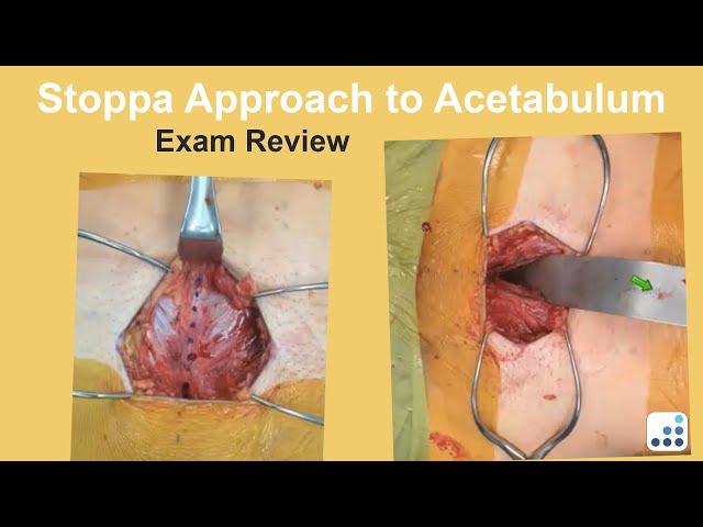 Stoppa Approach to Acetabulum Exam Review - Ben Taylor, MD