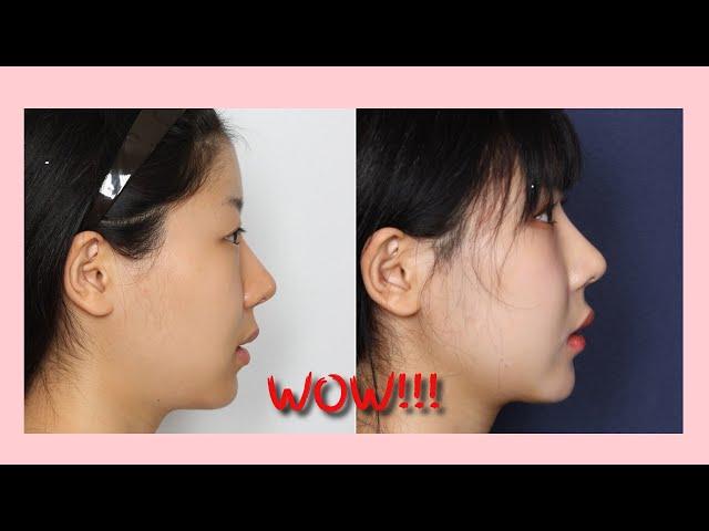 Face Design Plastic Surgery:  Stunning Before and After Transformation | Look Your Best!