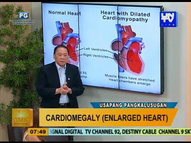 Good Morning Kuya: Cardiomegaly (Enlarged Heart)