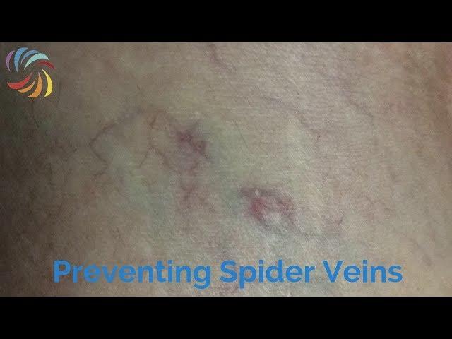 How to prevent Spider Veins?