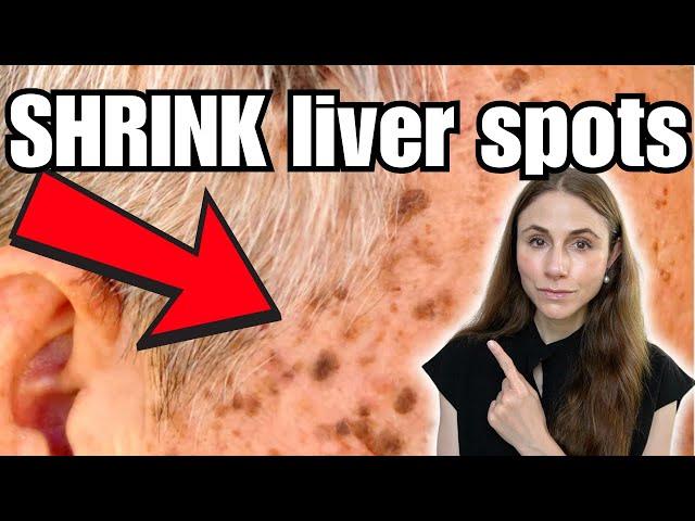 How To Shrink Liver Spots: Home Remedies THAT WORK