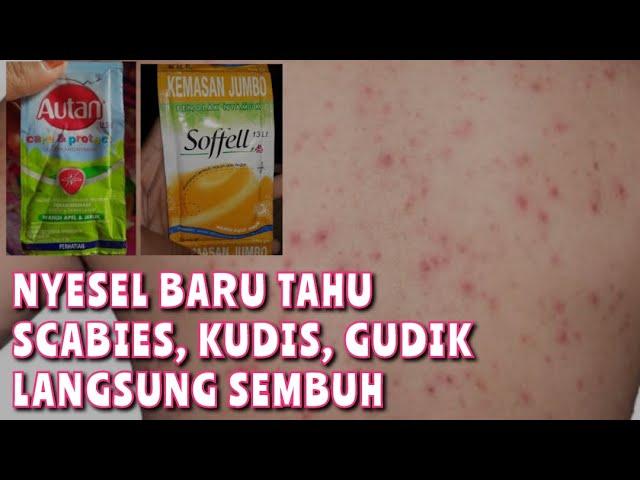 CARA MENGATASI GATAL SCABIES | AUTAN UNTUK SCABIES | @RinTans