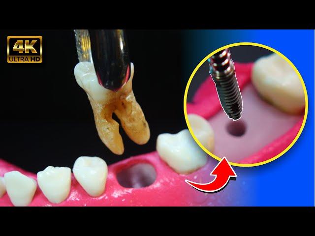 FASINATING dental IMPLANT process in 4K