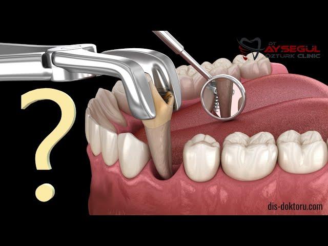 Tooth extraction