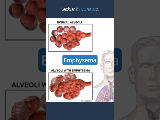 Exploring Emphysema  #Emphysema #RespiratoryCare #nclexrn