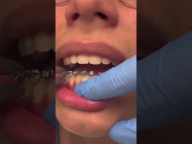BRACES OFF‼️So Satisfying‼️️‍