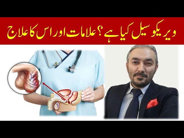 Varicocele Symptoms and Treatment | Varicocele ka ilaj in hindi/Urdu | Dr Fartash Sarwar