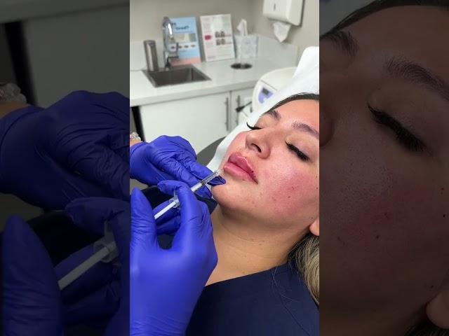 Juicy Lippies Filler Treatment by Our Cathy - Ageless MD