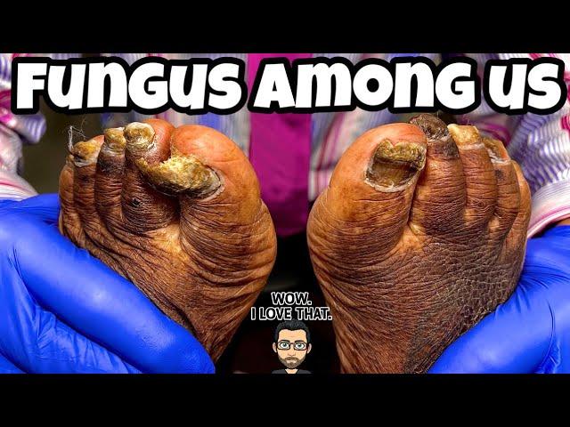 SUPER LARGE FUNGAL TOENAILS (INCREDIBLE TRANSFORMATION)