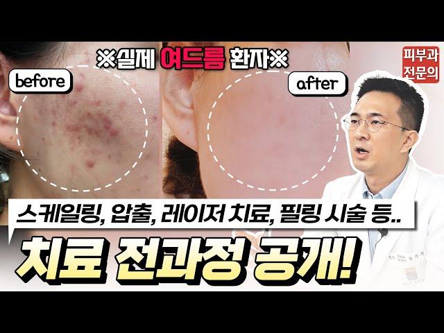 ※실제 여드름 치료 과정! | 환자 사례로 보는 확실한 여드름 치료 방법! | 전후사진 | 시술영상