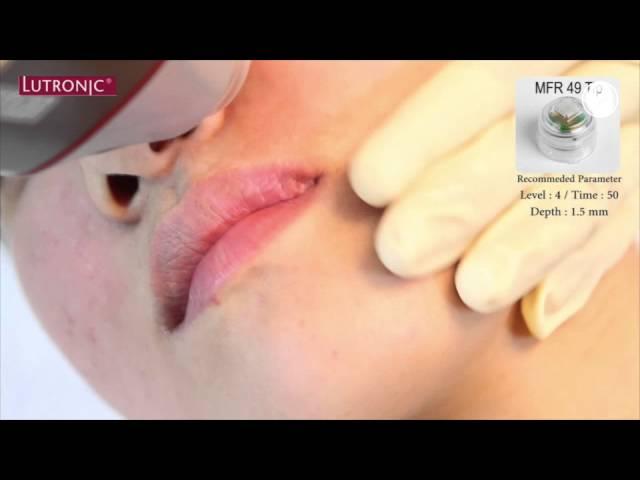 Lutronic Infini Non Surgical Natural Face Lift and Skin Tightening