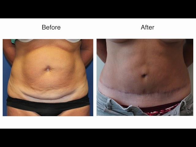 Tummy Tuck by Dr Damian Marucci