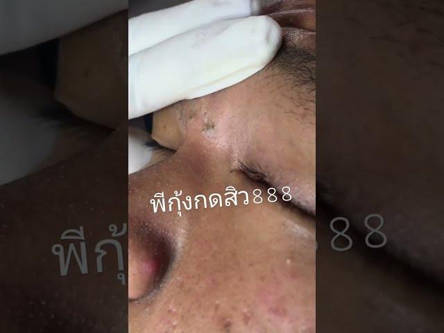 #พี่กุ้งกดสิว #สอนดูผิว #สิว  #มาส์กสาหร่ายลดสิว #ลูกศิษย์พี่กุ้ง #ceoพี่กุ้งกดสิว
