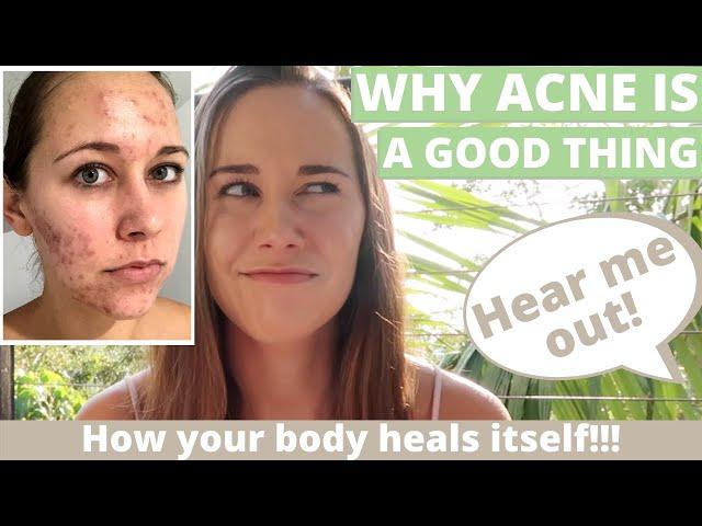 What Acne Is Telling You! (The Root Cause Approach in Naturopathy + What is Acne vulgaris)