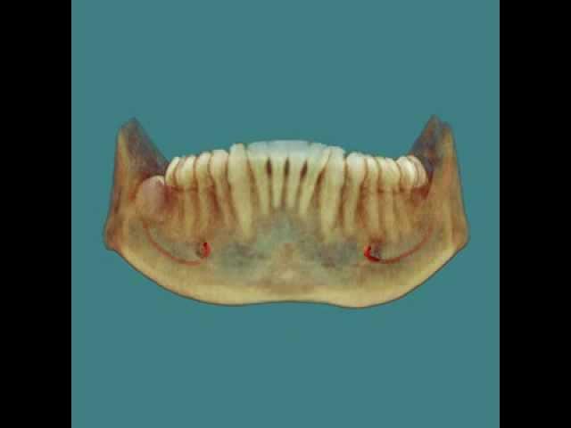 Impacted Third Molars - 3D Cone Beam CT Scan and Animation by SmartScan Imaging of Orange