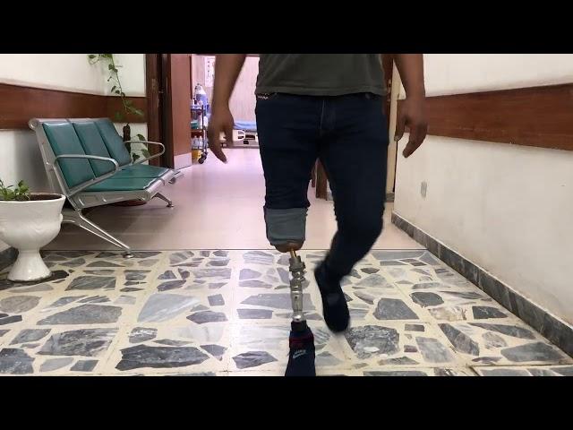 Osseointegration surgery for below knee amputee in Iraq.