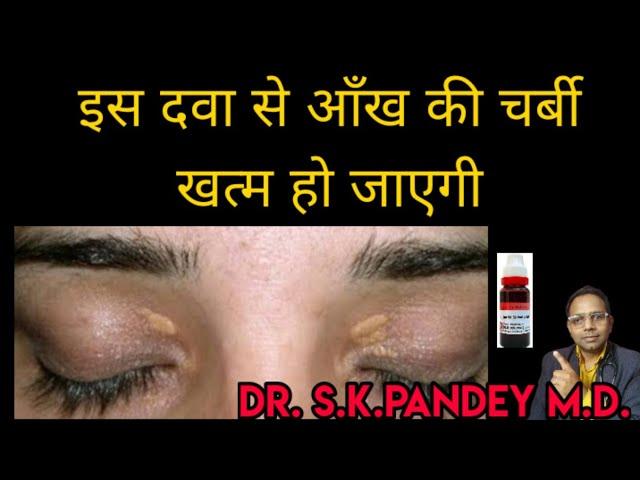 आँख की चर्बी 10 दिन में गल जायेगी /xanthelasma की सबसे अच्छी दवा  Dr. s.k.pandey M.D.