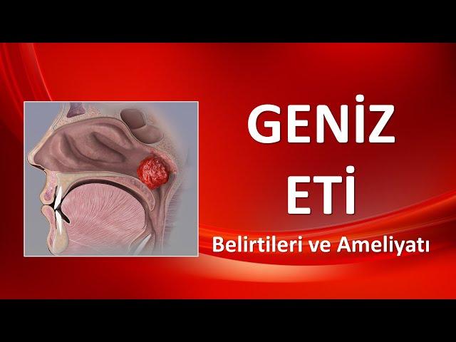 GENİZ ETİ Belirtileri ve Ameliyatı