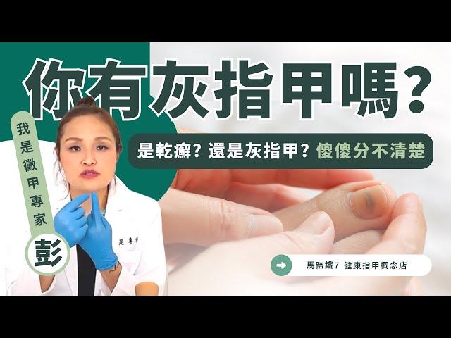 是乾癬? 還是灰指甲? 傻傻分不清楚｜馬蹄鐵7健康指甲概念店