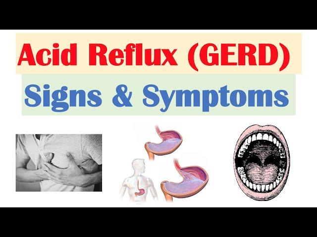 Gastroesophageal Reflux Disease (GERD) Signs & Symptoms (ex. Bad Teeth) | & Why They Occur