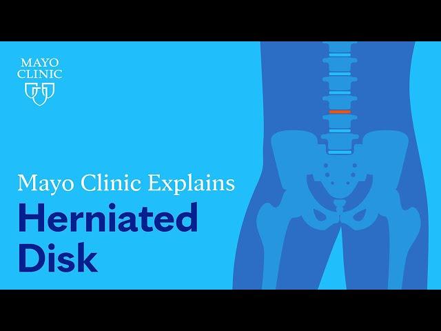 Mayo Clinic Explains Herniated Disk