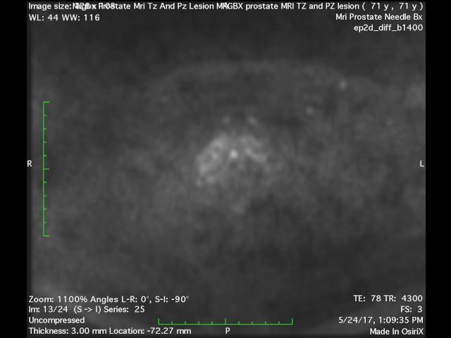 Mrgbx Prostate Mri Tz And Pz DWI with target in lesion