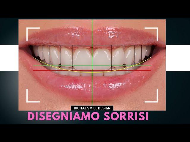 Metodo di applicazione delle faccette dentali - Studio Cannizzo Milano