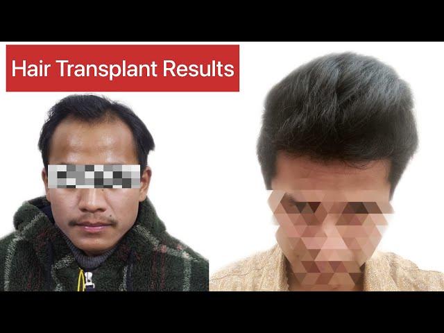 Hair Transplant Results 7 months timeline |