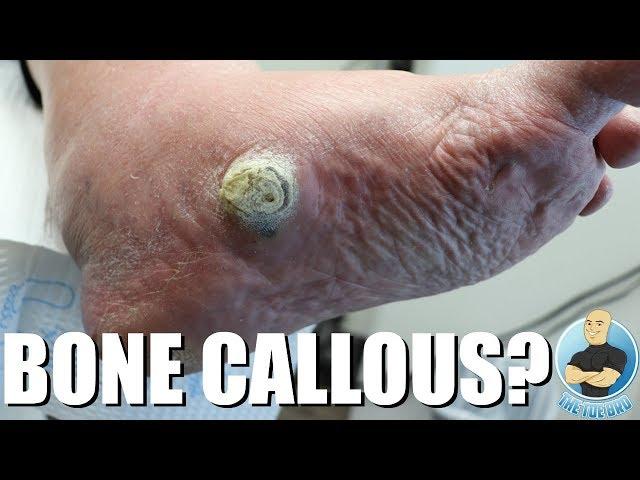 HUGE CALLOUS DUE TO COLLAPSED ARCH ***EXTREME CALLOUS REMOVAL***