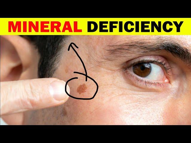 #1 Mineral To Remove Age Spots In People Over 50