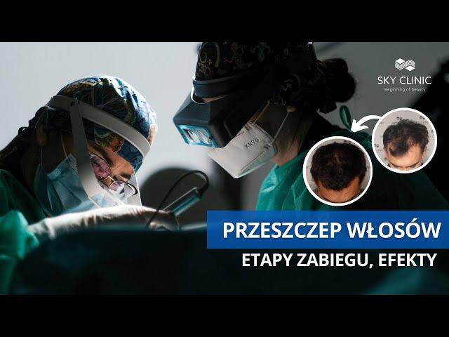 Na czym polega przeszczep włosów?  Najskuteczniejsze metody