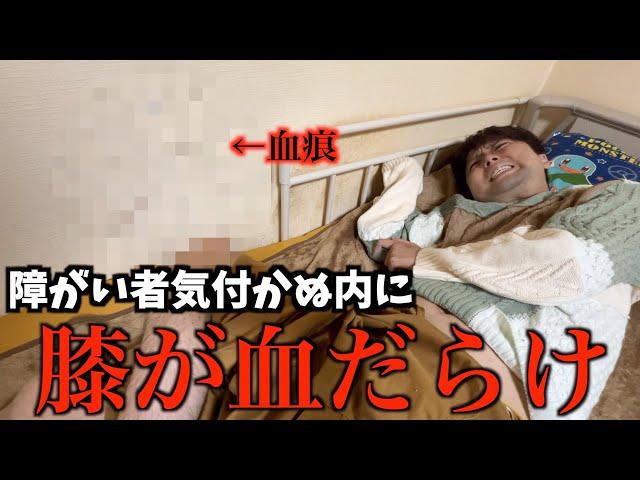 下半身麻痺の障がい者が睡眠中に膝を壁で傷つけてしまい気付かないまま血だらけに、、、