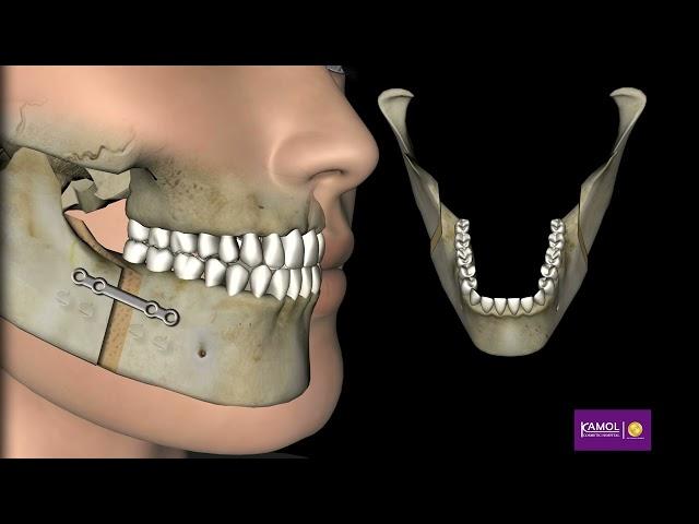 Mandibular Advancement for aesthetic beauty