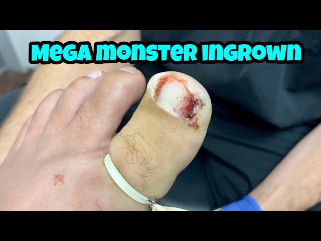 EXTRACTION OF BILATERAL MEGA INGROWN TOENAILS