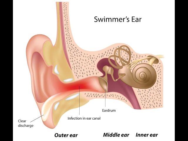 Otitis Externa