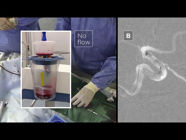 mSAVE technique for large ICA clots