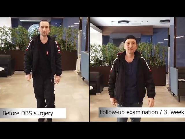 Change of Parkinson Patient Samandar Maksumov with DBS Treatment | Doç. Dr. Ali ZIRH