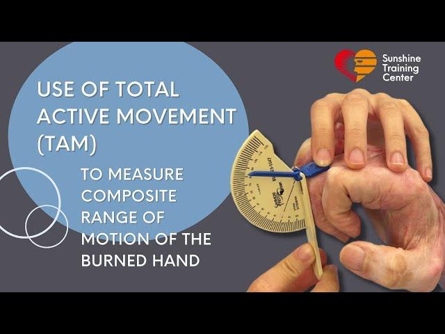 Using Total Active Motion to measure composite ROM of the burned hand