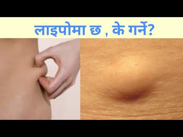 Lipoma in Nepali| Dr Bhupendra Shah|doctor Sathi