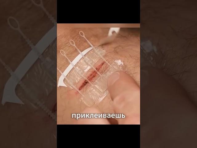 Забудьте про швы — это устройство лечит раны за секунды!