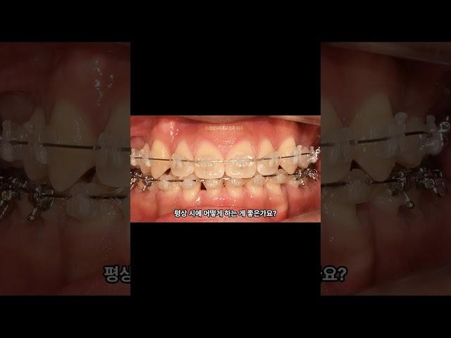 치아랑 교정장치 부딪히면 어떻게 해요?