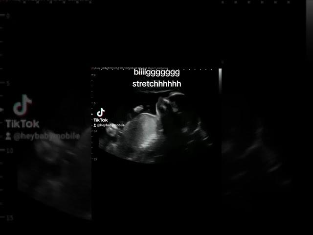 Baby Stretch at 25 Weeks 5 Days Pregnant on Ultrasound