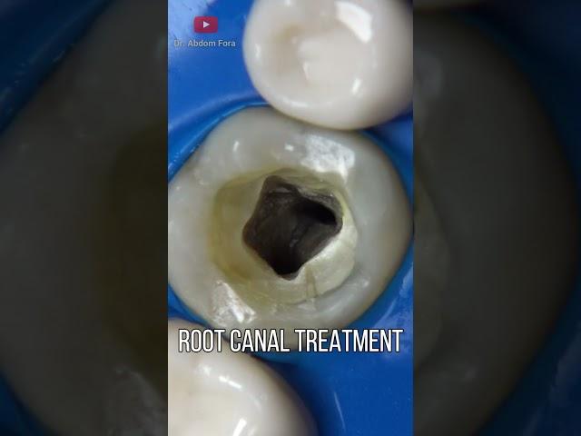 Endodontics or Root Canal Treatment in 4K