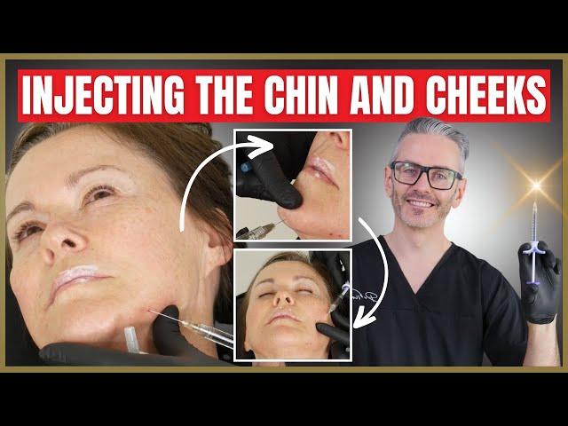 Injection Techniques | Dermal Filler Chin & Cheek Tutorial