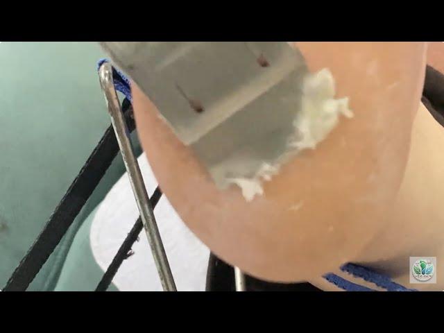 Callus and Hard Skin Removal